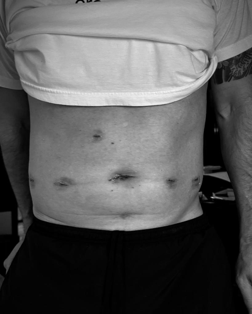 Colin Egglesfield post-op photo